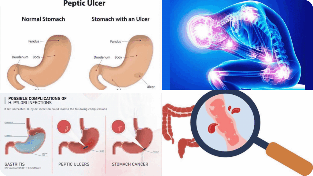 Possible complications of H. pylori infection including peptic ulcers gastritis and stomach pain treated at Al Samria Medical Center Jeddah 
